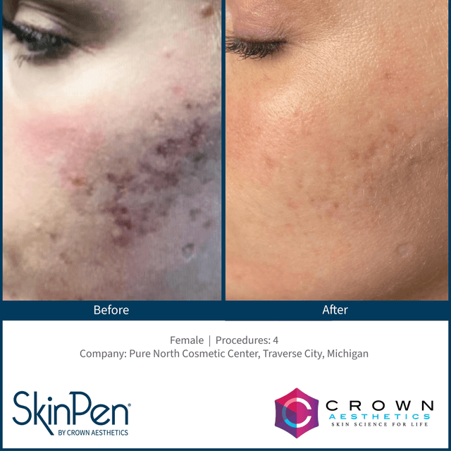 Microneedling (6) at Rachel Kerr Esthetics in lynnwood, WA
