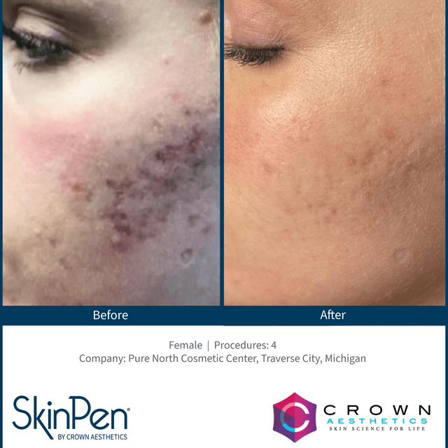 Microneedling (3) at Rachel Kerr Esthetics in lynnwood, WA